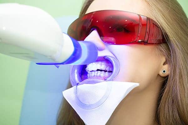 Laser teeth whitening treatments Luton