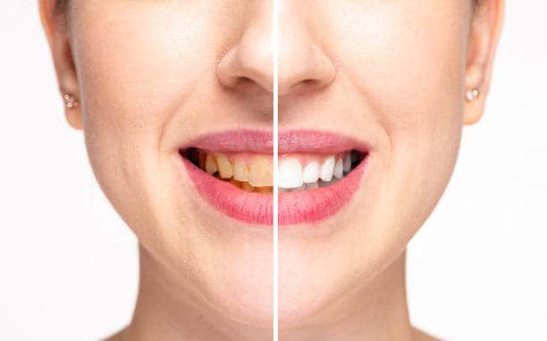 Teeth Whitening Milton Keynes Luton