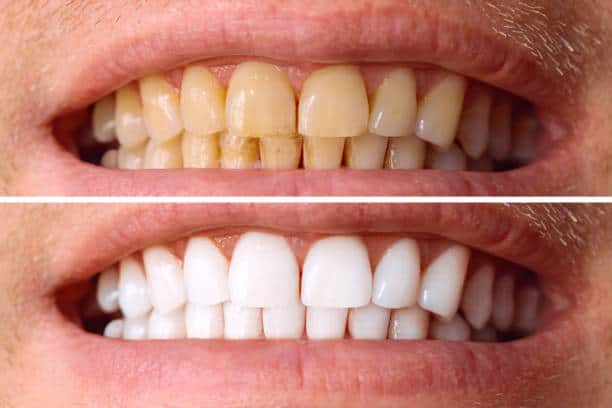 Laser White For Ever Bright – Get a Brighter, Whiter Smile with LA Teeth Whitening Luton