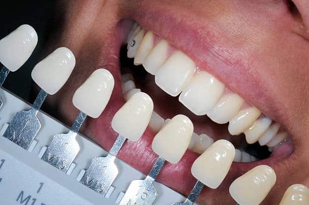 Get Natural and Stunning Smile with Teeth Whitening Results from LA Teeth Whitening Luton