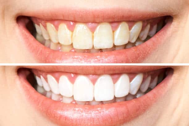 Achieve a Dazzling Smile for Your Special Day: A Guide to Wedding Teeth Whitening Luton