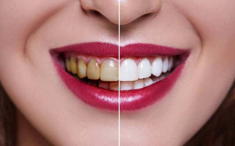 Teeth Whitening Ascot Windsor Luton