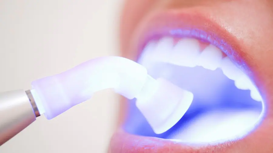 Teeth Whitening Aylesbury Luton