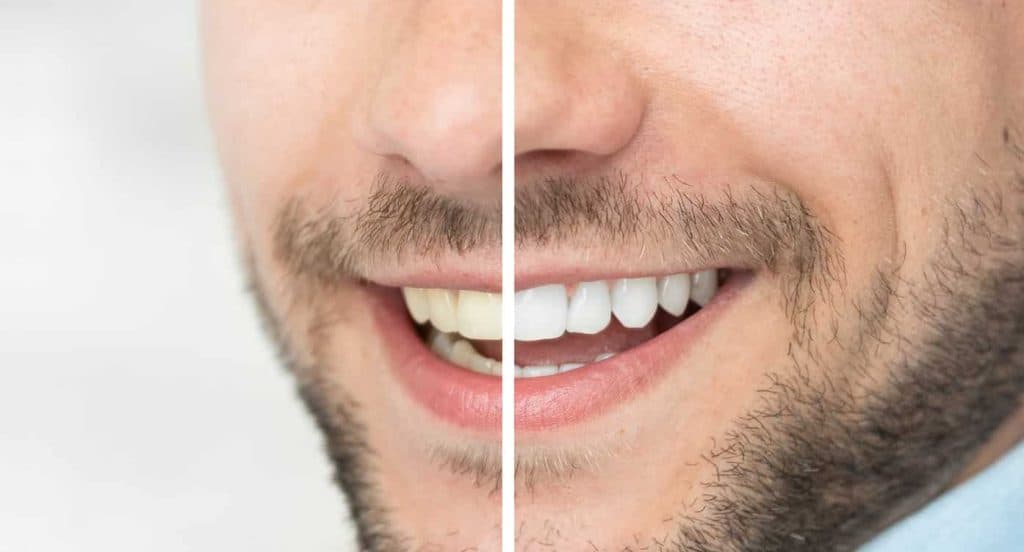 Teeth Whitening Bedfordshire Luton