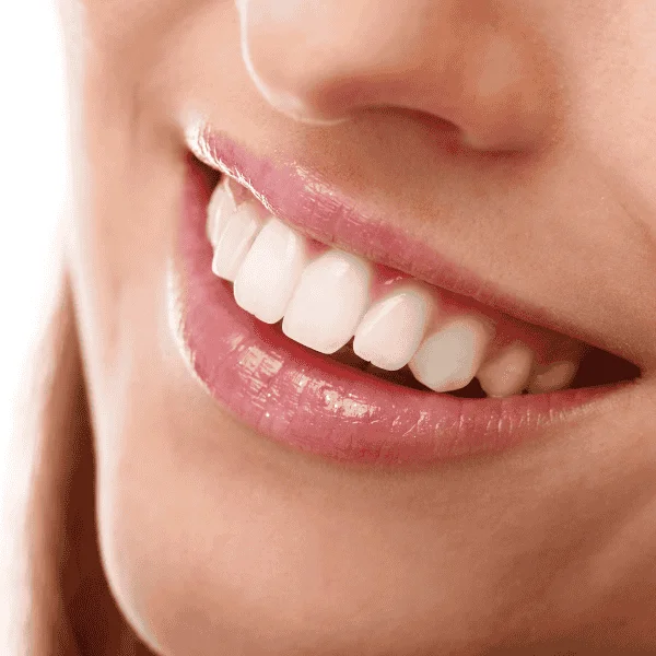 Looking for fast teeth whitening Luton? Contact LA Teeth Whitening Today! Luton